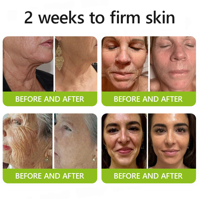 [🔥Last Day 70% OFF] ODALIT™ Botox & Retinol Shot - Eraser for Deep Wrinkles, Sagging Jowls & Puffy Eyes