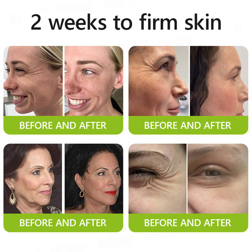 [🔥Last Day 70% OFF] ODALIT™ Botox & Retinol Shot - Eraser for Deep Wrinkles, Sagging Jowls & Puffy Eyes